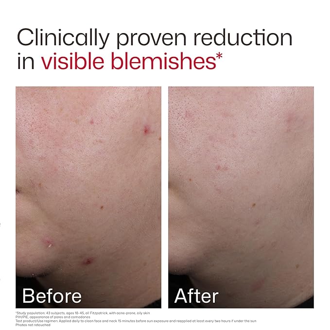 EltaMD UV Clear Blemish-Prone & Oil Balancing SPF 50, Non-Comedogenic Sunscreen with Zinc Oxide, Dermatologist Recommended